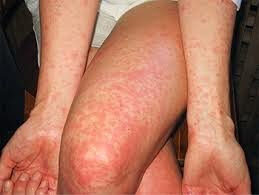 manchas2bpor2bdengue-3052085