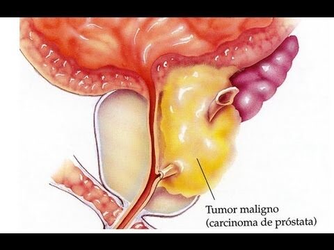 c25c325a2ncer2bde2bprostata-2653301